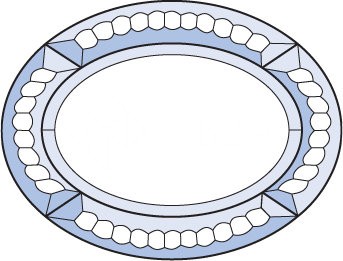 Бевелс AV153 фрамужный (5 элементов) 200 х 152 мм